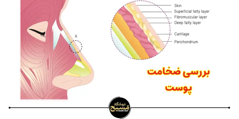 بینی گوشتی یا استخوانی؟ چطور تشخیص بدهیم؟ 1 ضخامت پوست بینی