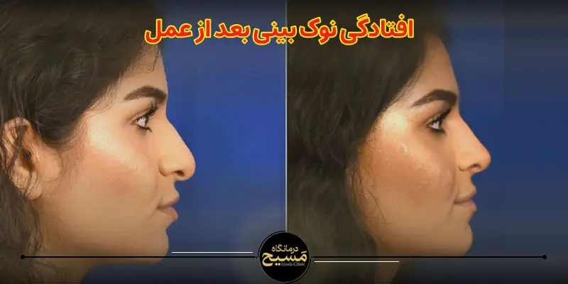 نوک بینی بعد از عمل چقدر پایین میاد 1 عکس افتادگی بینی بعد از عمل