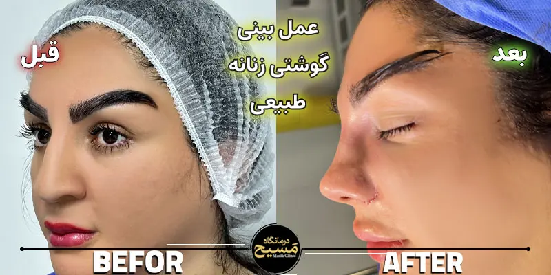 عمل بینی گوشتی زنانه طبیعی 3 قبل و بعد جراحی بینی زنانه گوشتی