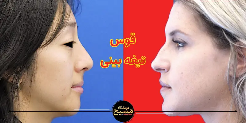 بینی گوشتی یا استخوانی؟ چطور تشخیص بدهیم؟ 3 قوس تیغه بینی