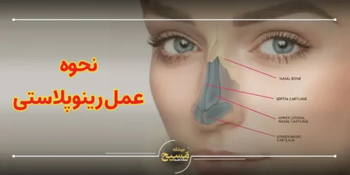نحوه عمل رینوپلاستی