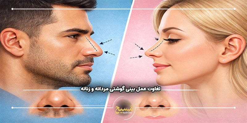 عمل بینی گوشتی مردانه 1 تفاوت عمل بینی گوشتی مردانه و زنانه چیست؟