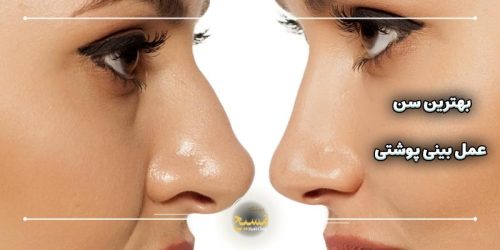 سن جراحی بینی گوشتی