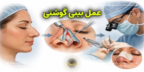 عمل بینی گوشتی