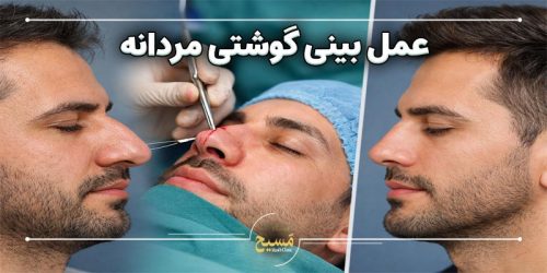 عمل بینی گوشتی مردانه