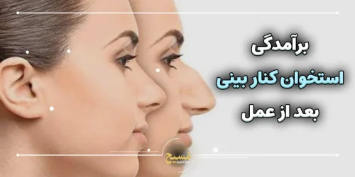 برآمدگی استخوان کنار بینی بعد از عمل
