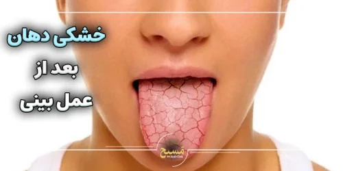 خشکی دهان بعد از عمل بینی