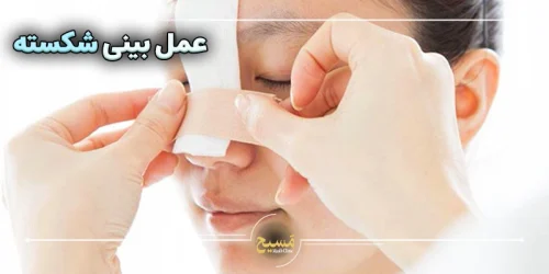 عمل بینی شکسته